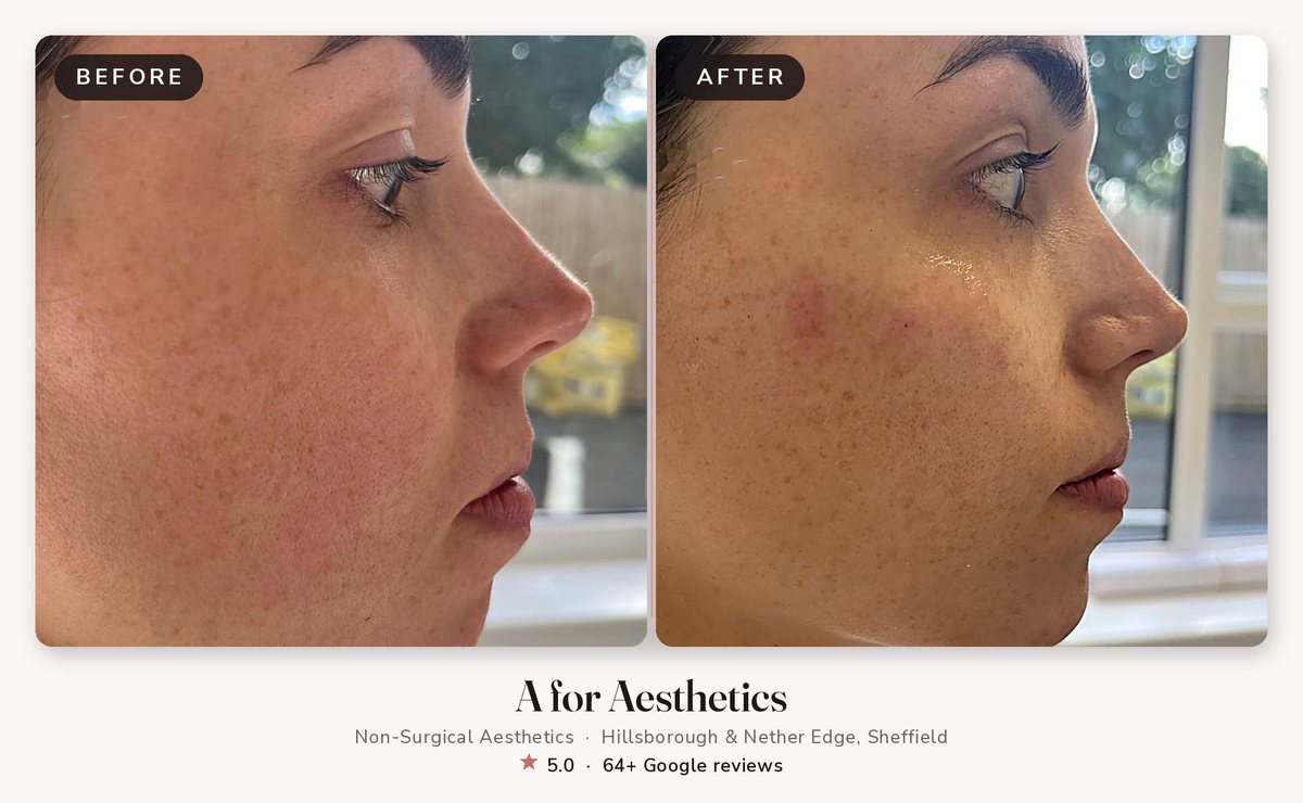 Cheek filler before and after — A for Aesthetics Sheffield