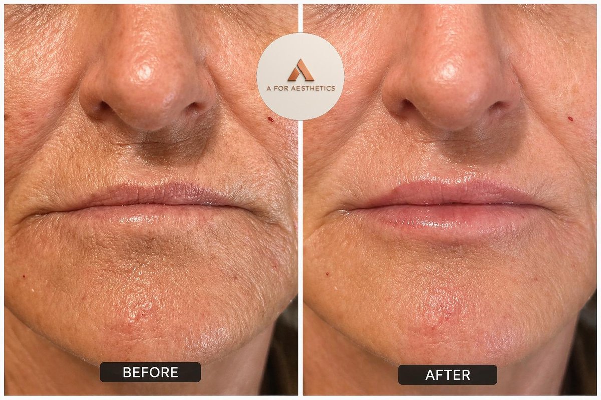 Lip filler before and after — A for Aesthetics Sheffield