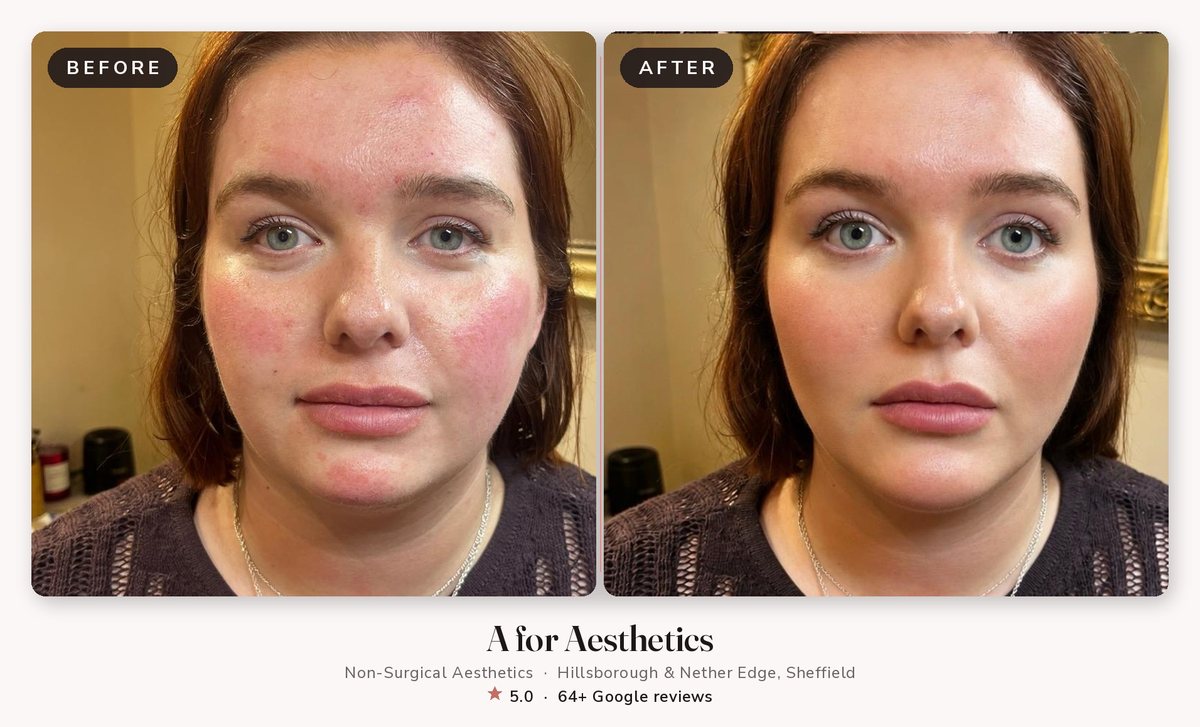 Skin booster before and after — A for Aesthetics Sheffield